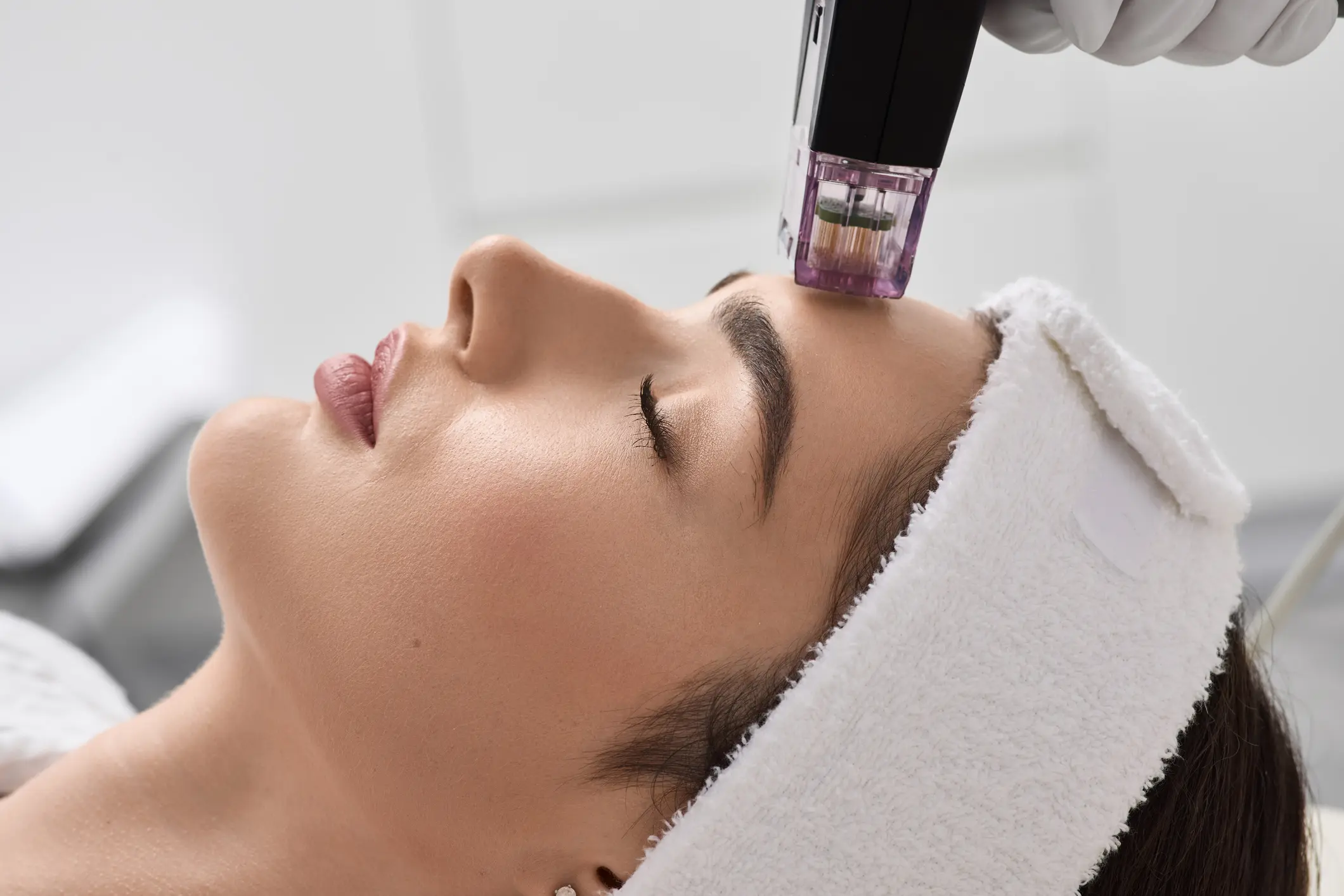 Non-surgical lifting of woman face with help of newest microneedle radio frequency lifting procedure. Rf lifting procedure at beauty parlour